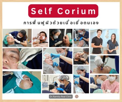 ฟื้นฟูหลุมสิวด้วยตัวเอง Self corium/dermal regeneration คืออะไร? เป็นการฟื้นฟูหลุมสิวด้วยเนื้อเยื่อตัวเอง