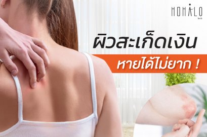 ปัญหาผิวสะเก็ดเงินรุมเร้า เราจะทำยังไงดี มีวิธีแก้ยังไงได้บ้าง?