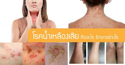 โรคน้ำเหลืองเสีย คืออะไร รักษาอย่างไร