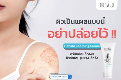ผิวเป็นแบบนี้อย่าปล่อยไว้  สะเก็ดเงิน  ผิวอักเสบรุนแรง  เรื้อรัง แก้เท่าไรก็ไม่หาย ลองแก้ด้วยสมุนไพรไทยด้วยครีม Hohalo Soothing Cream ครีมแก้สะเก็ดเงิน ผิวอักเสบ โรคผิวหนังทุกชนิด