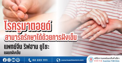 โรครูมาตอยด์สามารถรักษาได้ด้วยการฝังเข็ม