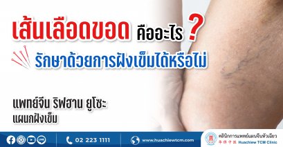 เส้นเลือดขอดคืออะไร รักษาด้วยการฝังเข็มได้หรือไม่