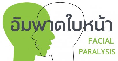 อัมพาตใบหน้า Bell’s palsy