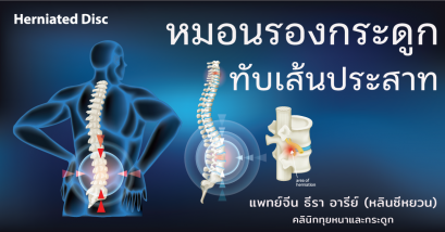 โรคหมอนรองกระดูกทับเส้นประสาท Herniated Disc