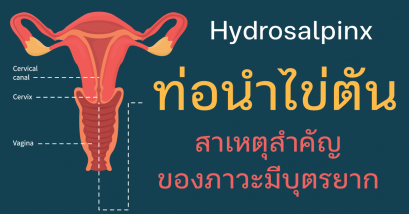 ท่อนำไข่ตัน สาเหตุของภาวะมีบุตรยาก