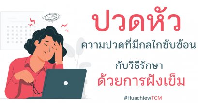 ปวดศีรษะกับการรักษาด้วยวิธีฝังเข็ม