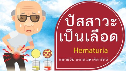 ปัสสาวะเป็นเลือด (Hematuria) ส่งเสริมการรักษาด้วยวิธีแพทย์แผนจีน
