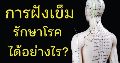 ฝังเข็มรักษาโรคได้อย่างไร ?