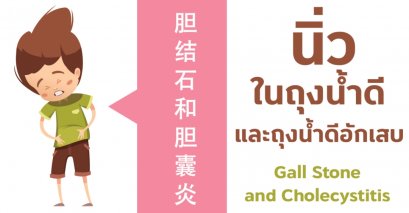 นิ่วในถุงน้ำดี และถุงน้ำดีอักเสบ Gall Stone and Cholecystitis 胆结石和胆囊炎 