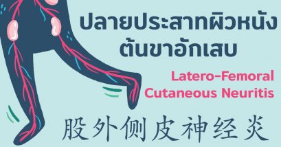 ปลายประสาทผิวหนังต้นขาอักเสบ