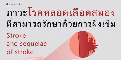 ภาวะโรคหลอดเลือดสมองที่สามารถรักษาได้ด้วยการฝังเข็ม