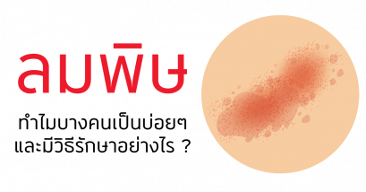 ลมพิษ ผื่นลม ผื่นซ่อนเร้น โรคผิวหนังเรื้อรังที่เป็นซ้ำแล้วซ้ำอีก