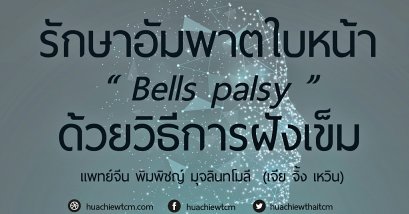 รักษาโรคอัมพาตใบหน้า Bells Palsy ด้วยการฝังเข็ม