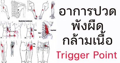 รักษาอาการปวดพังผืดกล้ามเนื้อ ด้วยวิธีทุยหนาแพทย์แผนจีน