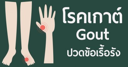 การรักษาโรคเกาต์ ปวดบวมตามข้อ