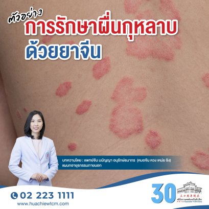 ตัวอย่างการรักษาผื่นกุหลาบด้วยยาจีน