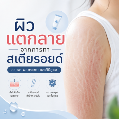 ผิวแตกลายจากครีมที่แอบผสมยาสเตอรอยด์