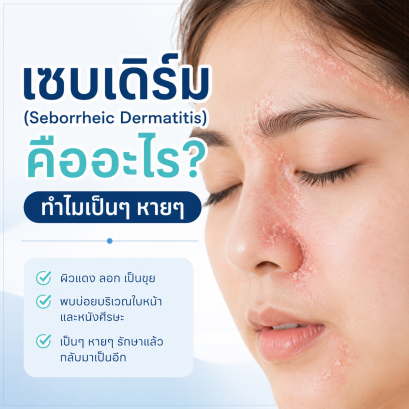 เซบเดิร์ม (Seborrheic Dermatitis) คืออะไร? สาเหตุ อาการ และวิธีรักษา  บทความโดยเภสัชกร 