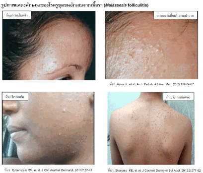 สิวยีสต์ สิวเชื้อรา สิวผด รักษายังไงดี