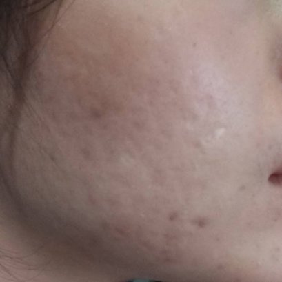 ผิวติดสาร มีวิธีขับสารออกหรือไม่