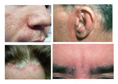 Seborrheic Dermatitis  เซบเดิร์ม   คืออะไร  บทความโดยเภสัชกร 
