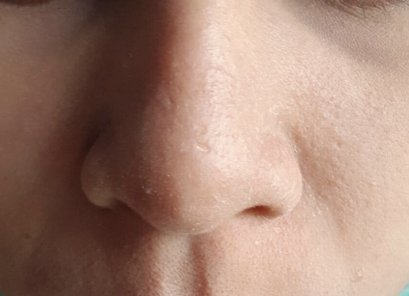 ผิวติดสารคืออะไร