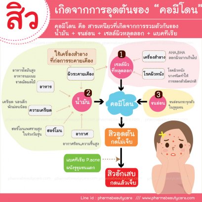 ประเภทสิว สิวมีกี่ประเภท สิวอุดตัน สิวอักเสบ สิวผด  บทความโดยเภสัชกร