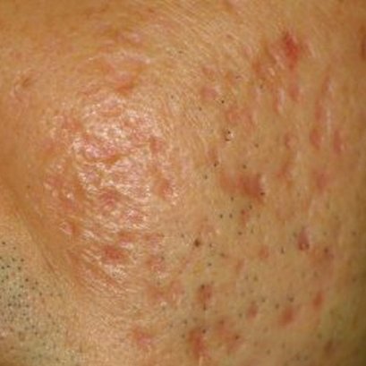 คอลลาเจนกับหลุมสิว!