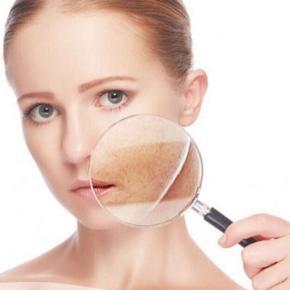 ไขความจริงเรื่องฝ้า กับหมอผิวหนังชื่อดัง สาเหตุ การป้องกัน วิธีรักษา ความเชื่อผิดๆ