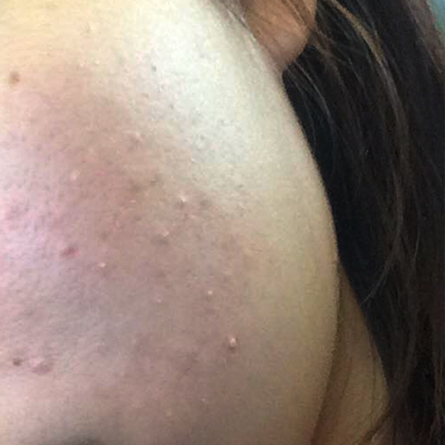 สิวขึ้นตอนท้อง อาจไม่ใช่สิวฮอร์โมนคนท้อง