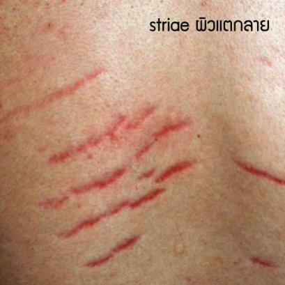 ผิวแตกลายจากครีมที่แอบผสมยาสเตอรอยด์