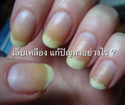 เมื่อเล็บเหลืองแก้ปัญหาอย่างไร 