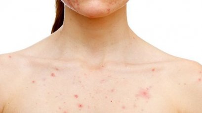 สิวเชื้อรา สิวยีสต์รักษายังไง