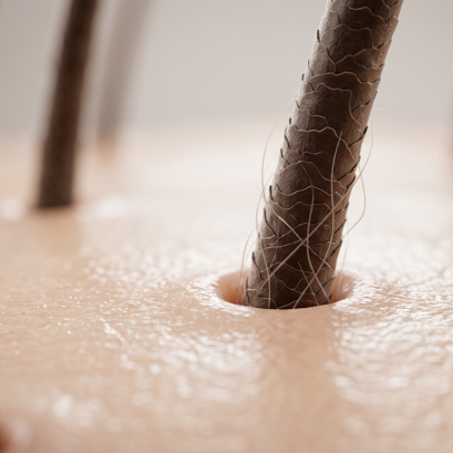 DHT คืออะไร? ทำไมถึงเป็นสาเหตุสำคัญของผมบางและผมร่วง