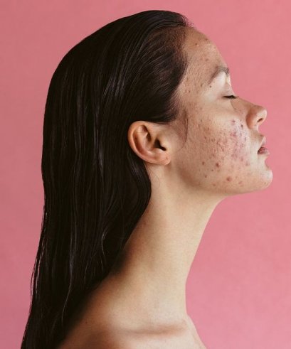 การเลือก Cleansing สำหรับคนเป็นสิวและผิวแพ้ง่าย