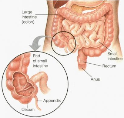 มะเร็งลำไส้