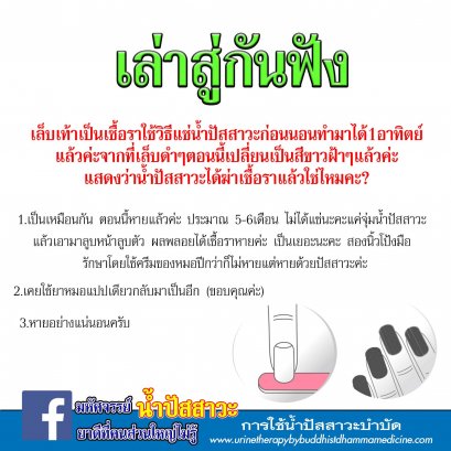 รักษาเชื้อรา ด้วยน้ำปัสสาวะ?