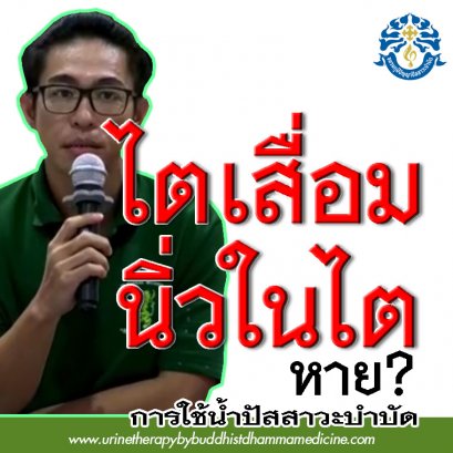 โรคไตเสื่อม ระยะ 4 นิ่วในไต รักษาด้วยวิธีง่ายๆ