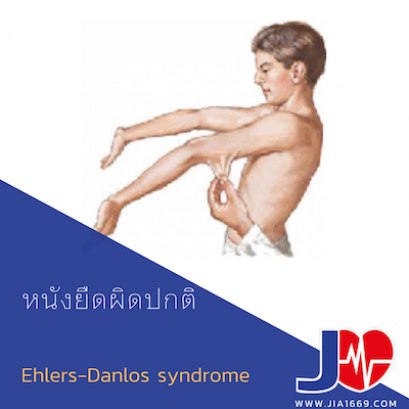 EHLERS-DANLOS SYNDROME โรคหนังยืดผิดปกติ