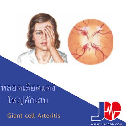 Giant Cell Arteritis หลอดเลือดแดงใหญ่อักเสบ