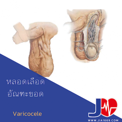 Varicocele หลอดเลือดอัณฑะขอด