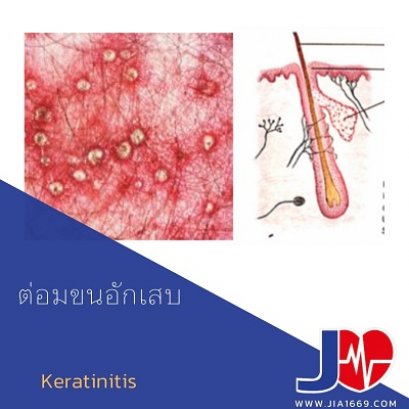 ต่อมขนอักเสบ
