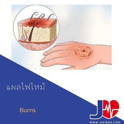 Burns 