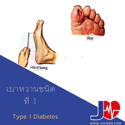 เบาหวานชนิดที่  1(DIABETES MELLITUS TYPE1)
