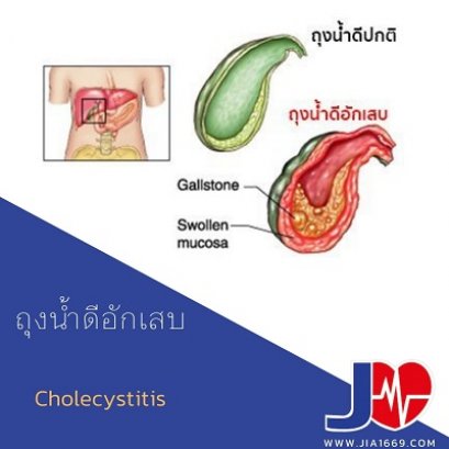 Cholecystitis ถุงน้ำดีอักเสบ