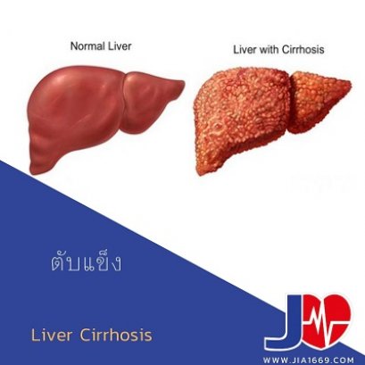 โรคตับแข็ง