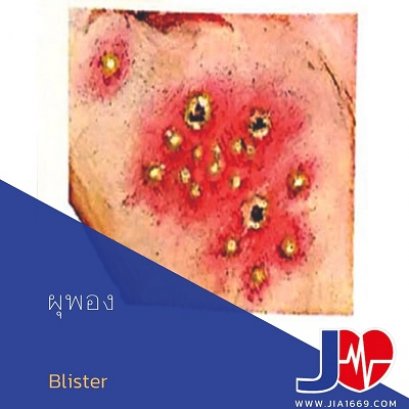 โรคผุพอง