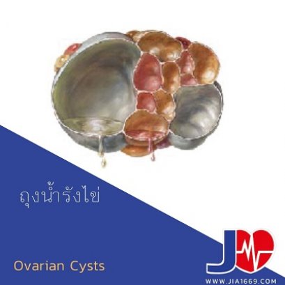 Ovarian Cysts