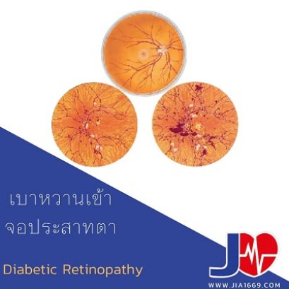 diabetic retinopathy