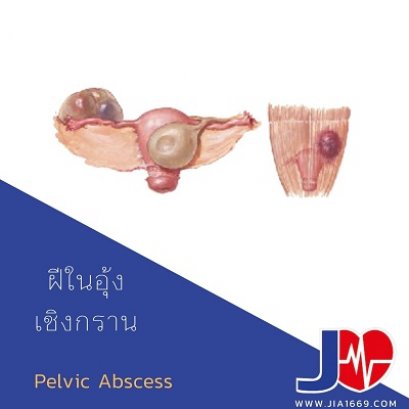 Pelvic Abscess